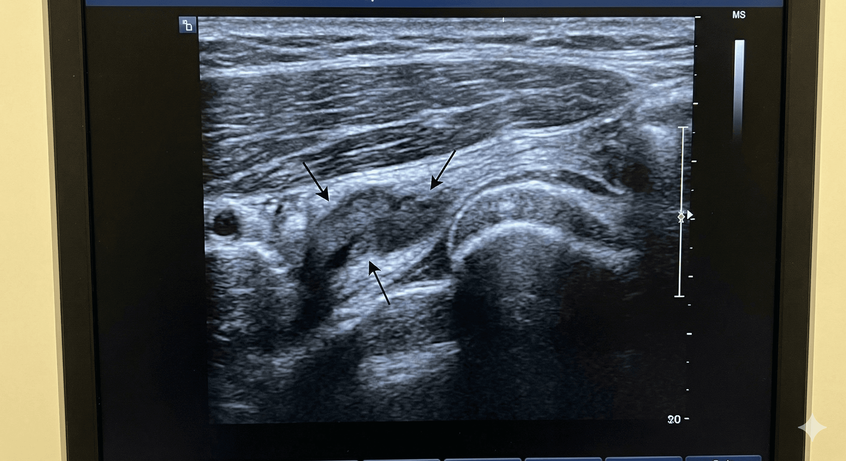 Tendinitis (Codo de tenista / golfista / Pata de ganso)